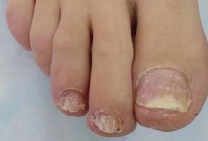 The nails have been badly affected by the fungus