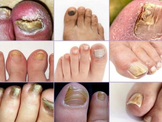 Damage to nails to different types of mushrooms