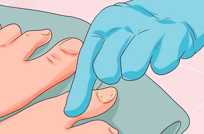 The first signs of nail yeast infection