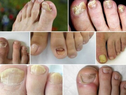 Various forms of nail fungus