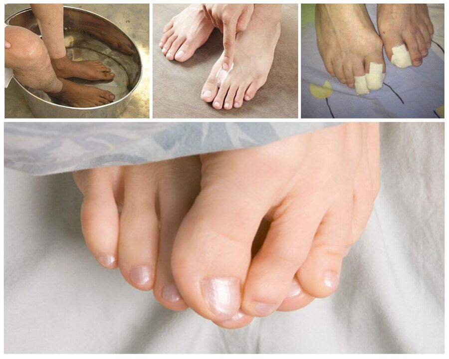 Mushroom treatment