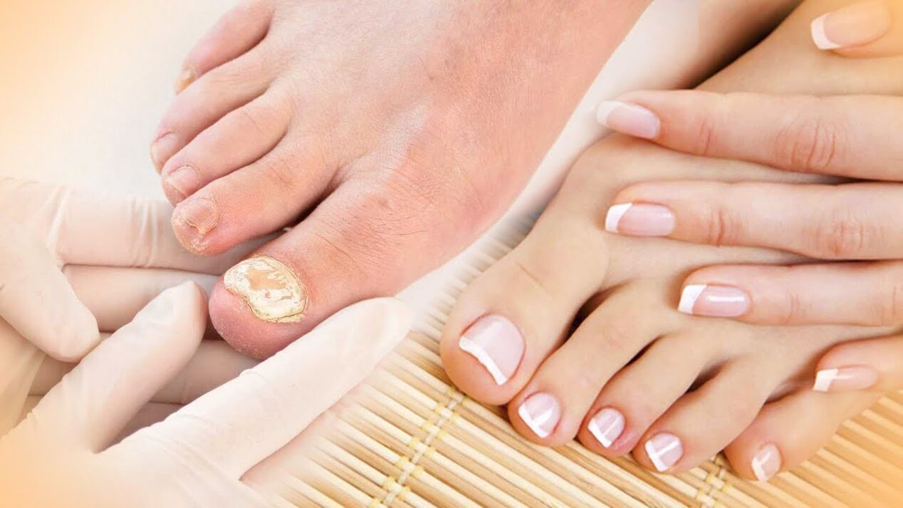 Nail mushroom