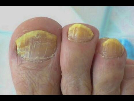 Mushroom treatment