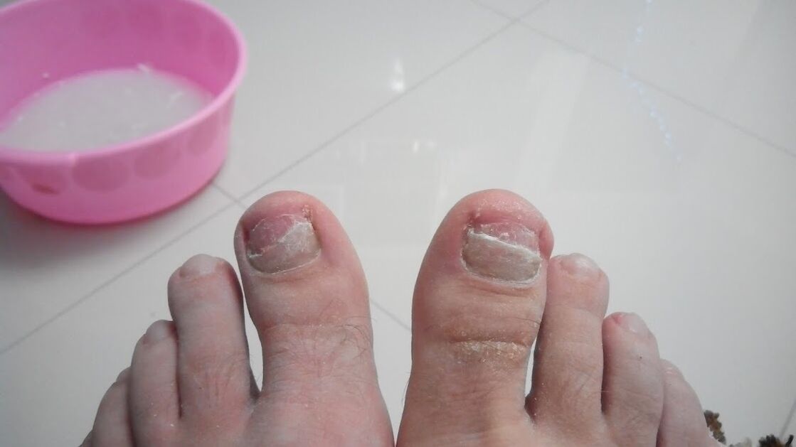 The fungus on the legs