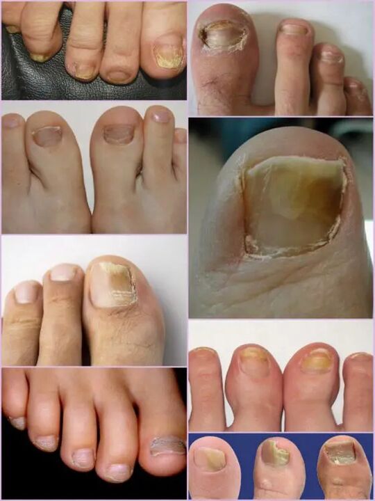 Nail mushroom varieties