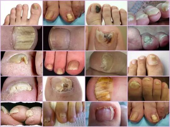 Onychomycosis of various location on the nail