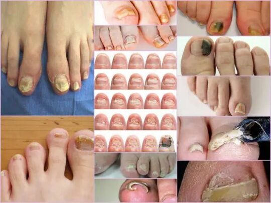 Onychomycosis varieties