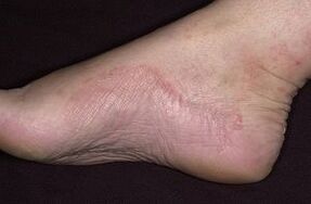 Fungal damage to the foot