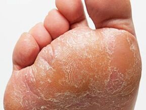 The foot fungus