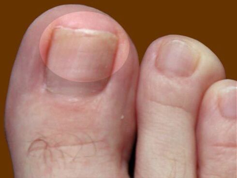 The mushroom lesion