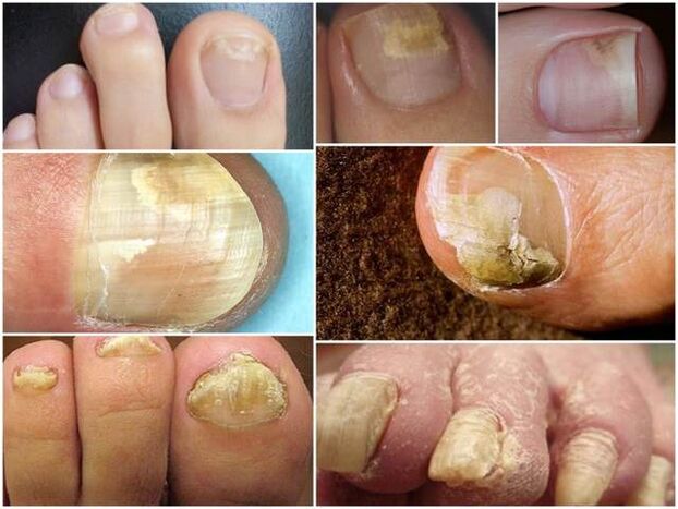 infection