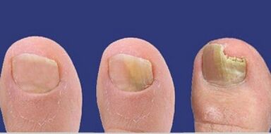 Nail mushroom development steps